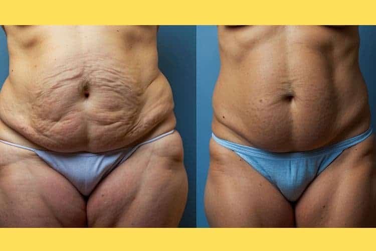 Stomach Fat Removal Without Surgery